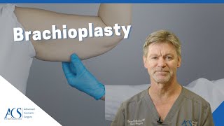 Brachioplasty Surgery Explained By Plastic Surgeon What is it Scars Recovery and More [upl. by Nylirek]