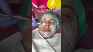 Pico Laser Treatment pemutih [upl. by Afton14]