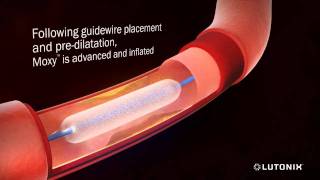 Angioplasty for Restenosis with Paclitaxel 3D Animation [upl. by Elbon]