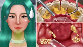 ASMR Old Tonsil Stone Removal Animation‼️Makeup The cause of Bad Breath [upl. by Alaham996]