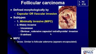 Thyroid Carcinoma Gross and Micro [upl. by Parnas]