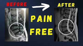 L4 L5  L5 S1 disc herniation recovered pain free without surgery [upl. by Leifeste289]