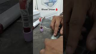 Prepare Perfect blood smear Blood film preparation Blood smear labor hematology laboratory [upl. by Iuqcaj249]