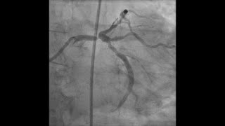 Left main PCI for distal lesion with caliber mismatch [upl. by Edan]