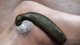 Skin diseases therapy  Leech । रक्तमोक्षण । जलौकावचरण । जळू  Leech [upl. by Wadell928]