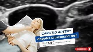 Carotid artery Doppler ultrasound test Accurate examination to perform a basic ultrasound carotid [upl. by Lempres]