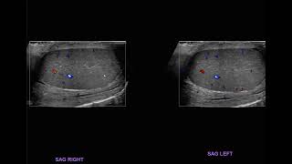 ultrasound epididymoorchitis [upl. by Sacha37]