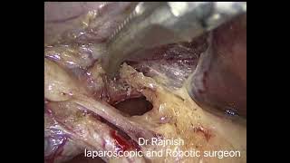 laparoscopic cholecystectomy [upl. by Verina]