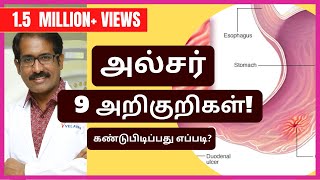 அல்சர்வயிற்றுப்புண் 9 அறிகுறிகள் என்ன கண்டுபிடிப்பது எப்படி Ulcer Symptoms amp Diagnosis [upl. by Peh]