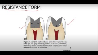 Class 1 Cavity Preparation  Operative Dentistry  Crystal Clear Concepts [upl. by Epotimet]