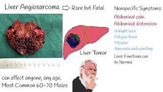 Liver angiosarcoma  Symptoms and treatment liver angiosarcoma prognosis life expectancy [upl. by Ansaev974]