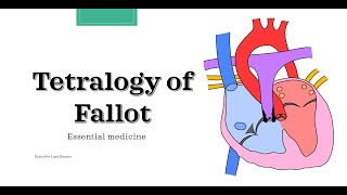 Tetralogy of Fallot Essential medicine [upl. by Katzen304]