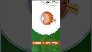 Floaters  vit detachment  Floaters  Posterior Vitreous Detachment PVD  SBH Hospital [upl. by Japheth]