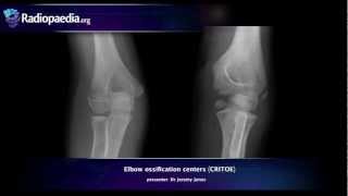 Elbow ossification centers CRITOE  radiology video tutorial [upl. by Amuwkuhc895]