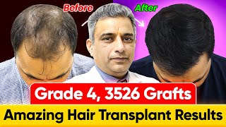 Hair Transplant Results in Agra 3526 Grafts Norwood Grade 4  Cost of Hair Transplant in India [upl. by Amund140]