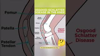 What is Osgood  Schlatter Disease physiotherapypainmodalitiesyoutube [upl. by Ariew]