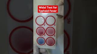 Widal Test for Typhoid and Paratyphoid Fever  Salmonella Agglutination Test [upl. by Rehttam]