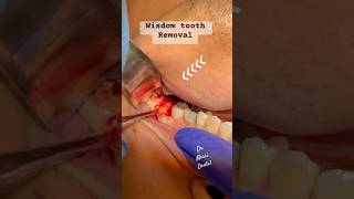 Wisdom tooth removal pain free [upl. by Anirtik943]