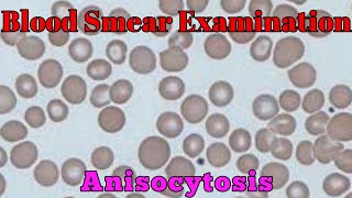 Blood Smear Examination Anisocytosis Macrocytic and Microcytic blood cells blood smear Lecture 2 [upl. by Eastman]