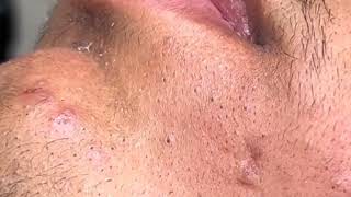 Yummy comedonal acne  how to get rid of acnes on the face  acne pimple remove blackheads [upl. by Harrison651]