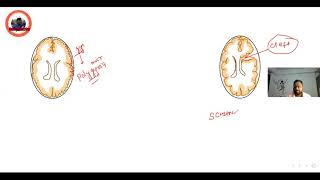 neuronalmigrationdefect porencephaly schizencephaly lissencephaly [upl. by Setarcos1]