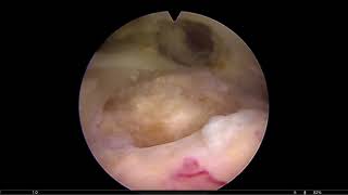 Schulterarthroskopie mit einfacher Rotatorenmanschettennaht [upl. by Tletski380]