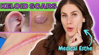 How To Treat Keloid Scars At Home  Is It Possible Why Do Keloid Scars Happen [upl. by Ybbor]