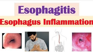 Esophagitis [upl. by Neely]