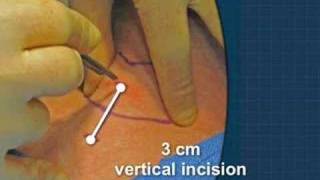 Cricothyrotomy [upl. by Itaws]