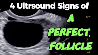 A Perfect Follicle  4 Ultrasound Signs  of Good Follicle for Easy Conceiving [upl. by Rilda182]