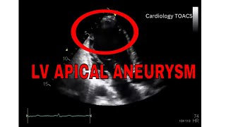 Left Ventricular Apical Aneurysm  ECHO [upl. by Nabe100]