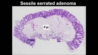 Serrated polyps Learn to tell the difference between hyperplastic polyp and sessile serrated lesion [upl. by Fotinas620]