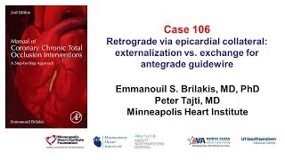 Case 106 Manual of CTO interventions Retrograde via epicardial collateral [upl. by Essirehc138]