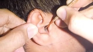 Something Stuck in Mans Ear for Months  What Is It [upl. by Avra543]