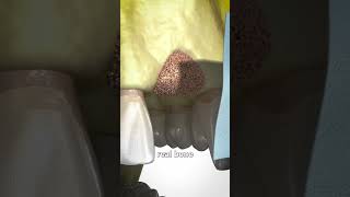 How Does Bone Graft Work [upl. by Letsyrk268]