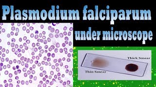 plasmodium falciparum under microscope  TrophozoitesSchizontGametocytesclear explain [upl. by Dorca]