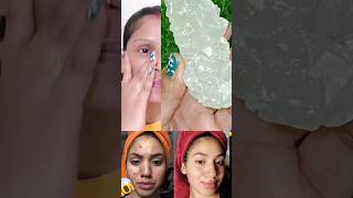 fitkari ke fayde face ke liye  jhaaeyo ko kaise hataye  remove pigmentation shorts ytshorts [upl. by Yenrab]