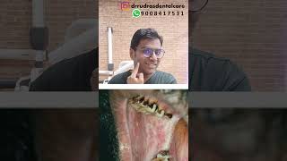 Dr Rudra Mohan Oral Sub Mucous FibrosisOSMFdrrudrasdentalcare drrudramohan osmf osmftreatment [upl. by Burney]