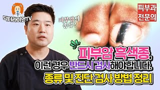 피부암 흑색종 의심증상 정리 종류 및 진단검사방법은 🧐 [upl. by Darrel661]