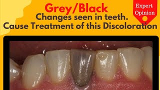 Why is tooth changing into greyblack colour How to Treat discoloration of Teeth [upl. by Esmerolda]