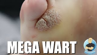 MONSTER MOSAIC WART REMOVAL [upl. by Cypro]