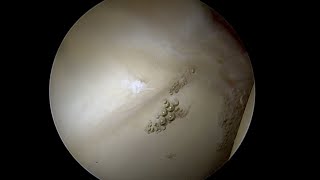 Debonded Articular Cartilage Lifting off the Bone as Labrum is Stressed [upl. by Dunham]