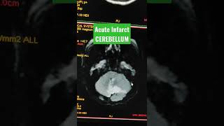 Large Acute Infarct in Cerebellum viral youtubeshorts mri [upl. by Secnirp]