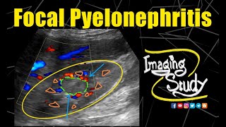 Focal Pyelonephritis in Pregnancy  Ultrasound  CT  Case 192 [upl. by Ahsenrad]