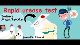 Rapid Urease test for detecting Helicobacter pylori H pylori infection [upl. by Ylrebme]