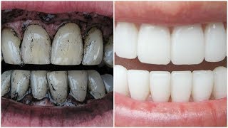 3 Way to Whiten Your Yellow Teeth Naturally [upl. by Adnam]