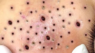 Deep blackhead extraction videos Unbelievable blackhead removal 2022 [upl. by Torre]