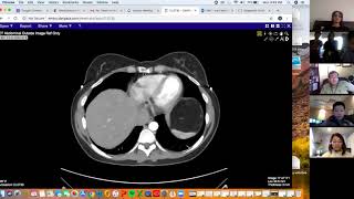 Large retroperitoneal mass  Aarti Sekhar  Liposarcoma [upl. by Aisela]