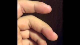 Major fasciculation in middle finger  Muscle twitching [upl. by Samara]