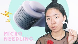 How To Heal Acne Scars with Microneedling  Before amp After [upl. by Roseline]